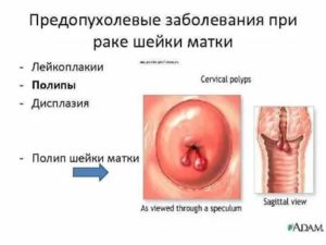 Можно нащупать опухоль на шейке матки