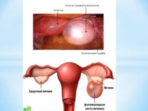 Почему образовывается в маточных трубах кисты