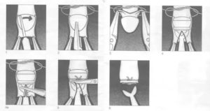 Помогает ли обрезание при простатите