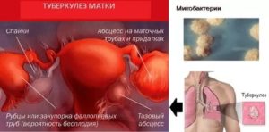 Туберкулез женских половых органов бесплодие