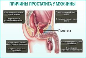 Простатит что это можно ли заразить девушку