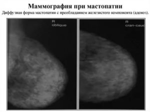 Чем опасен поликистоз молочной железы