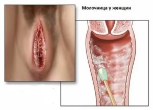 Застудила ноги может ли из за этого быть молочница