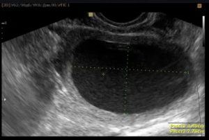 На узи в матке небольшое скопление жидкости что это