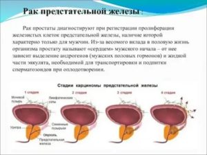 Можно ли жить половой жизнью при раке предстательной железы