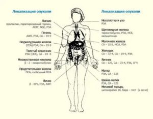 Анализ крови на онкомаркеры рака яичек