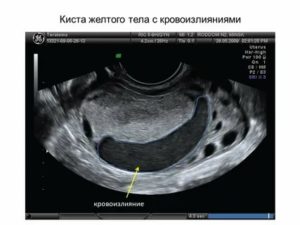 Узи признаки недостаточности желтого тела при беременности