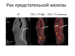 Кт предстательной железы с холином