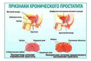В чем разница между хроническим и острым простатитом