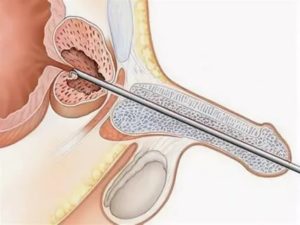Как образуется стриктура уретры после тур простаты