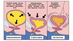 Почему при климаксе частое мочеиспускание у