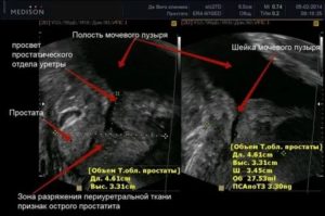 При узи предстательной железы за сколько времени пить воду и сколько