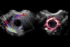 На узи плохо работают яичники