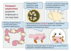 Что такое кандидозная инфекция лечение