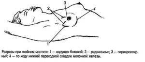 Как делают операцию при гнойном мастите