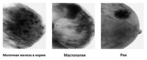 Может ли рентген грудной клетки показать рак молочной железы