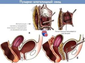 Как делают операцию по пузырно-влагалищный свищ