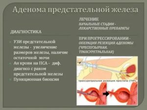 Лечение солью аденомы предстательной железы профессор окулов