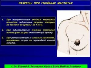 Как делают операцию при гнойном мастите