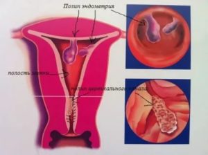 Удаление плацентарного полипа матки гистероскопией