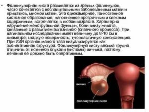 Как вылечить кисту яичника гомеопатией отзывы