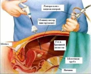 Для чего делают пункцию при кисте яичника