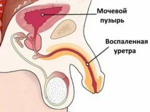 Не могу нормально пописать нет напора простатита нет