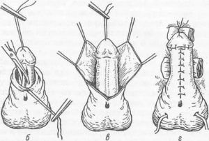 Какую операция делают мужчинам на половом органе