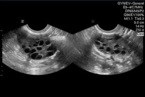 Что такое мультикистозные яичники и как это лечить