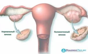 Когда начнутся месячные после лапароскопии яичников при поликистозе отзывы