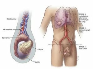 Что такое рак яичек у мужчин и как его лечат