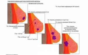 Как определить размер опухоли молочной железы