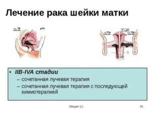 Химиолучевая терапия рак шейки матки рекомендации russco