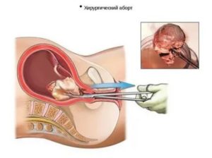 Почему нет месячных после выскабливания замершей беременности