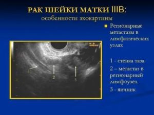 Могут ли быть метастазы при 2 стадии рака шейки матки