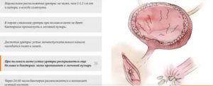 Что такое цистит и можно от полового партнера им заразиться