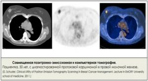 Что показывает кт легких при раке молочной железы