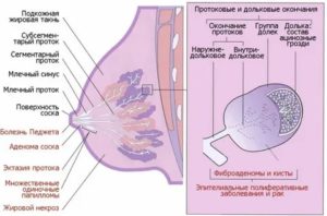 Эндометриоз и рак молочной железы лечение