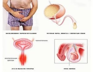 Лечение хронического гонорейного простатита