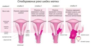 Могут ли быть метастазы при 2 стадии рака шейки матки