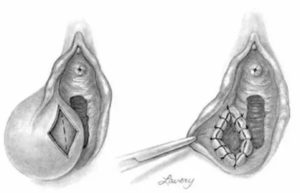Что такое марсупиализация кисты бартолиновой железы отзывы