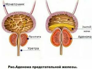 После тур аденомы простаты белые хлопья в моче