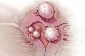 Может ли фиброма матки перейти в рак