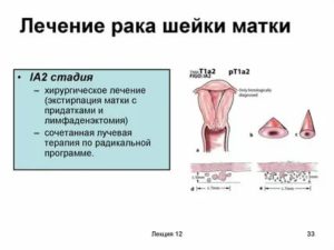 Что такое рак шейки матки степени симптомы лечение