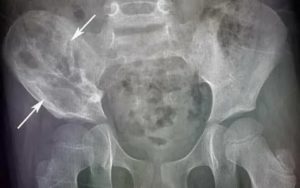 Рак подвздошной кости из-за рака простаты