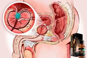 Как улучшить кровоснабжение в простате