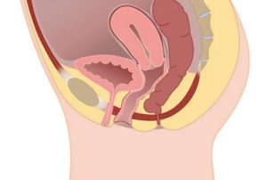 Как вести себя после операции цистоцеле