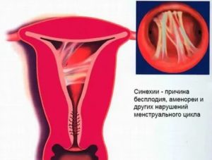 Как быть с синехиями в матке в постменопаузе