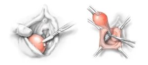 Что такое марсупиализация кисты бартолиновой железы отзывы