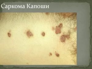 Как выглядит саркома капоши при вич